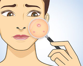 Acne - Some Alternative Therapies